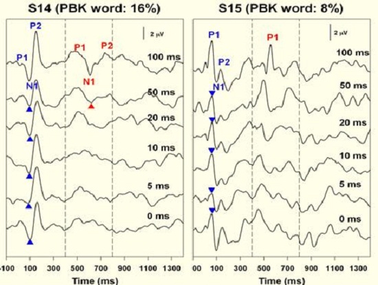Results from two subjects who exhibited poor word recognition after receiving their cochlear implants