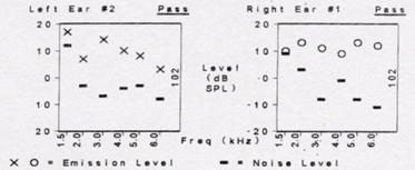 ABR tracings in the presence of OAEs