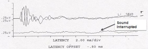 ABR tracings in the presence of ANSD