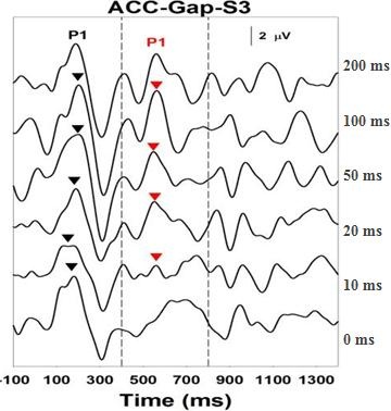 Acoustic Change Complex for a child with ANSD who is an excellent hearing aid user