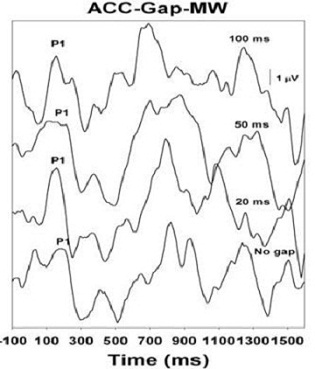 Gap detection results of child with 60 dB hearing loss, and with little to no language or auditory progress