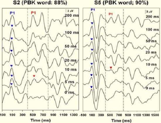 Results from two subjects who exhibited good word recognition after receiving their cochlear implants