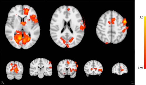 Whole brain effects of neurofeedback training