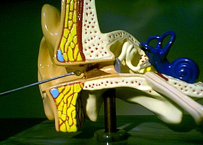 Cross-section of ear with cerumen accumulation in the canal