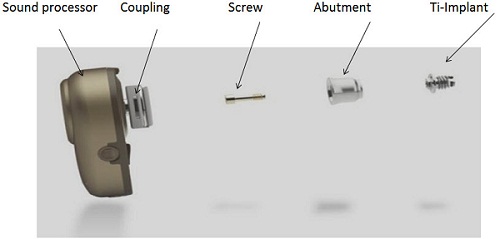 Bone-anchored hearing system including the sound processor, abutment, and titanium implant