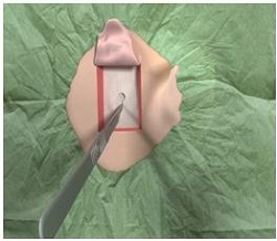 Removal of subcutaneous tissue beneath skin flap revealing the periosteum underneath
