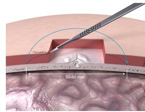 Tissue reduction under skin flap