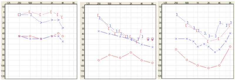 Audiograms of patients who are candidates for bone-anchored technology