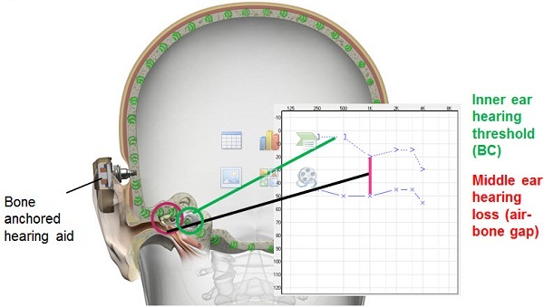 The bone-anchored sound processor bypasses the middle ear and stimulates the cochleae directly, overcoming the audiometric air-bone gap