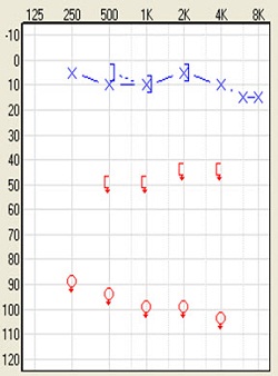 Audiogram of single-sided deafness