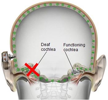 Direct transcranial bone conduction, transmitting sounds to both cochleae