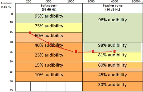 Audiogram overlaid on audibility chart. Even a slight-to-mild audiogram limits audibility