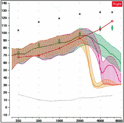 Example showing nonlinear frequency compression hearing aid