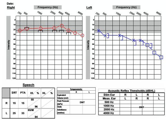51-year old with asymmetrical audiogram and acoustic neuroma on the left side