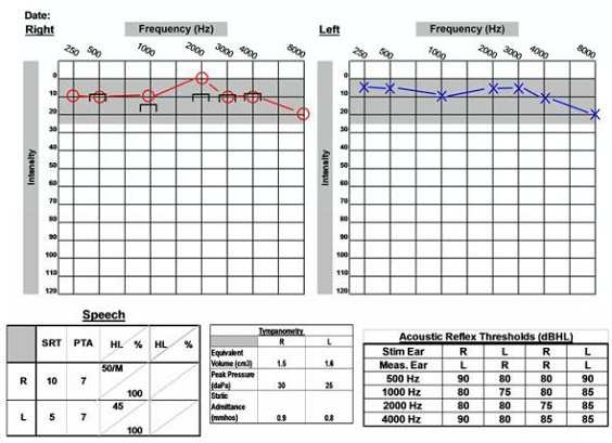 61-year old with normal audiogram and acoustic neuroma on the right side