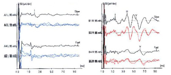 ABR tracings of patient with acoustic neuroma on the left side