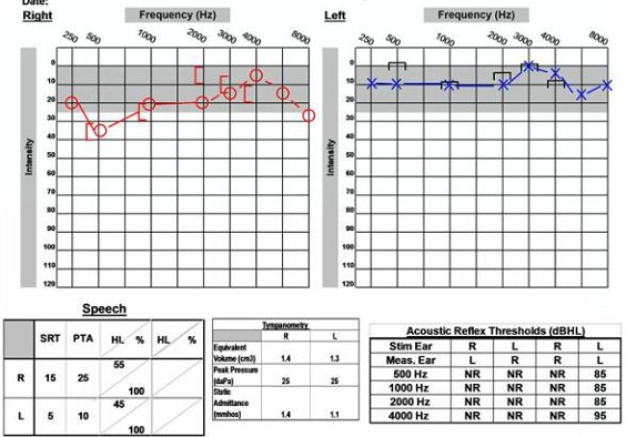 Audiological data for 16-year old with NF2 and acoustic neuroma on the right side