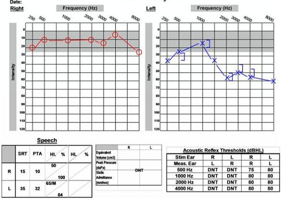 Audiological data for a 59-year old male with acoustic neuroma on the left side accompanied by abnormal ABR and normal VEMP