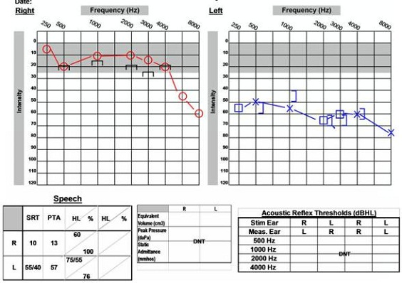Post-operative audiological data of 59-year old male with preservation of word recognition abilities
