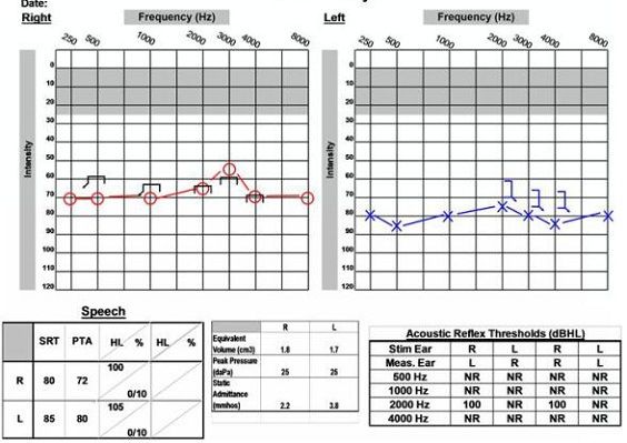 Audiological data of 58-year old female with sudden hearing loss and right acoustic neuroma