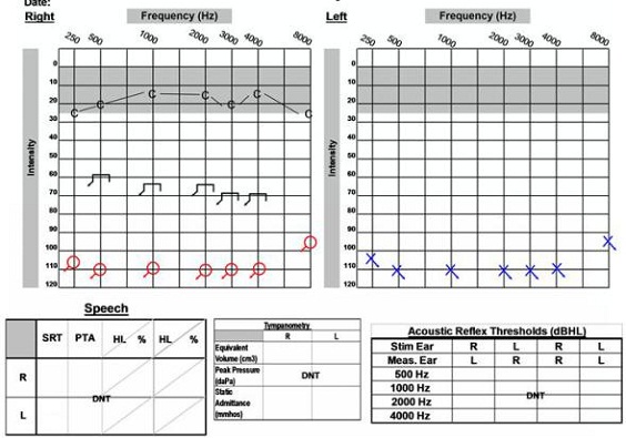 Post-operative audiogram of 58-year old female with left acoustic neuroma on the right side which was removed and post cochlear implantation on the right ear