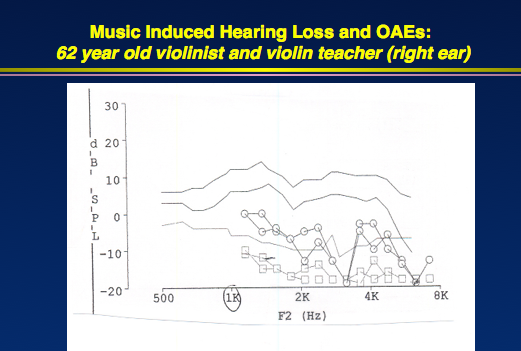 OAEs in right ear from 62-year-old violinist, indicating cochlear dysfunction that did not manifest on the audiogram