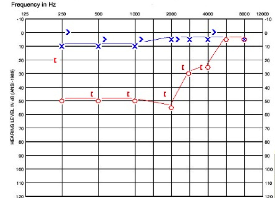 Audiogram of child in case A