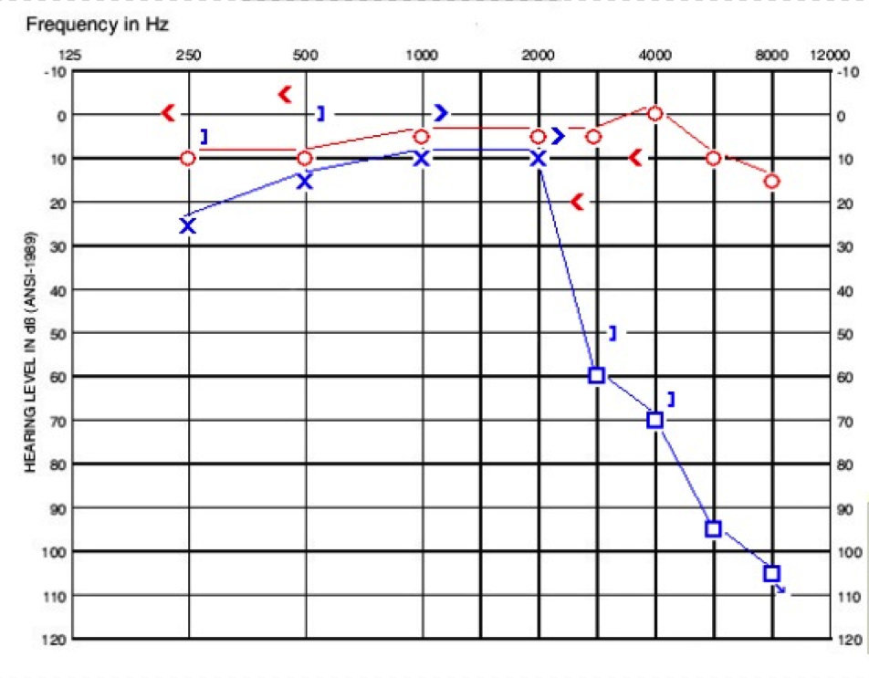 Audiogram of child in case B
