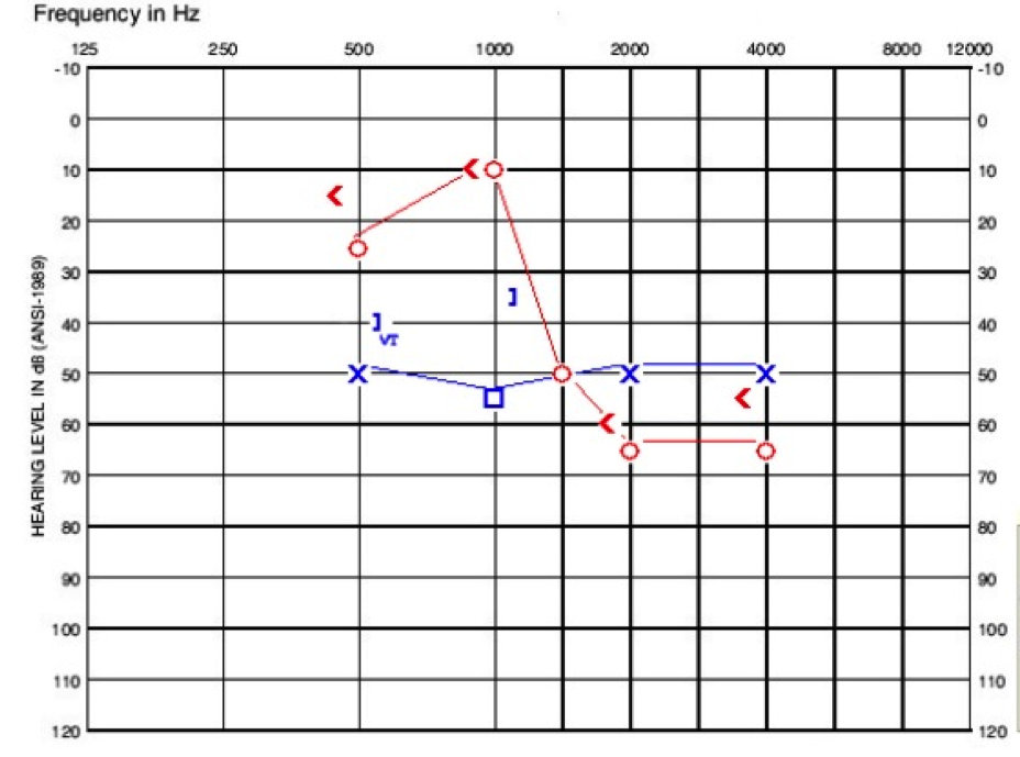 Audiogram of child in case C