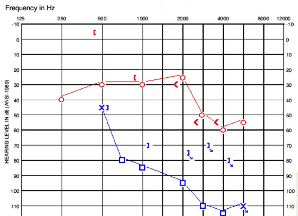 Audiogram of child in case D