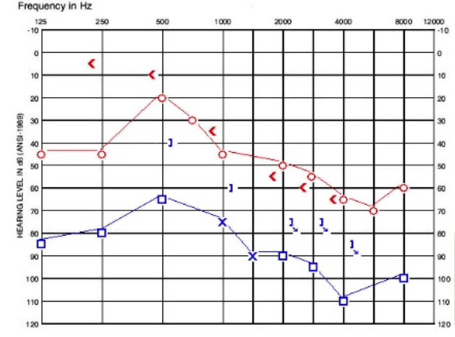 Case study D audiogram one year after presenting in clinic