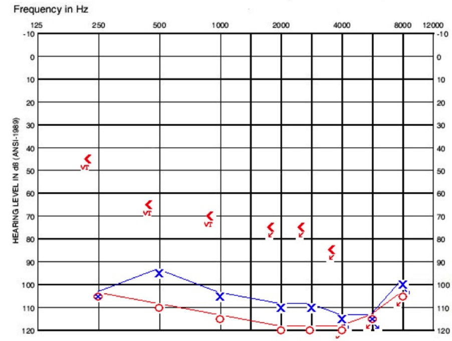 Cochlear implant evaluation audiogram for patient with bilateral EVA