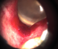 Small hematoma located in the ear canal