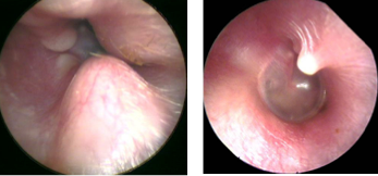 Exostoses and osteoma