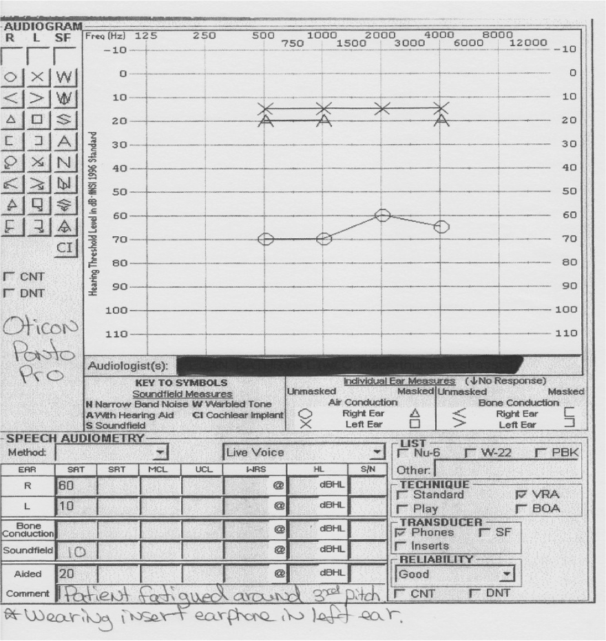 Audiogram showing conductive hearing loss in the right ear, with aided results in the normal range while using the Oticon Ponto Pro