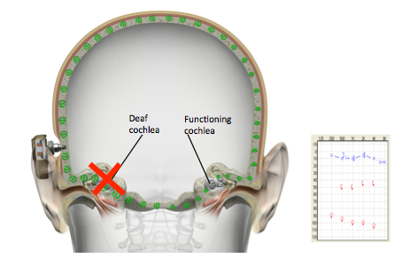 For SSD, the bone anchored hearing system works as a CROS device