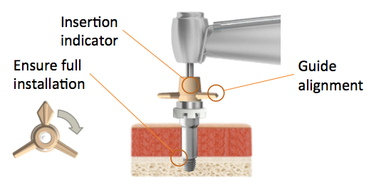 Implant installation includes an insertion indicator