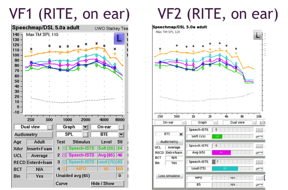 On-ear verification of a RITE hearing aid with Verifit 1 and Verifit 2