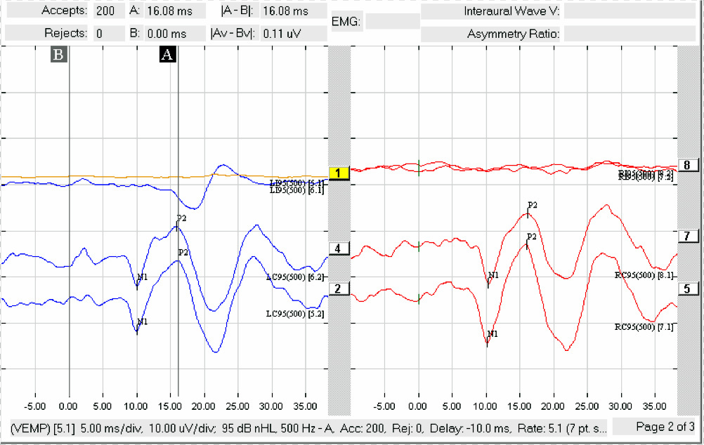 oVEMP recording showing left contralateral and right contralateral responses