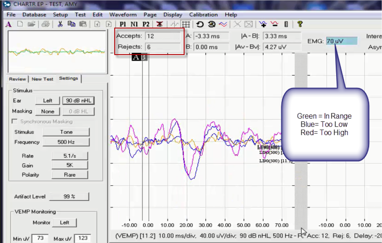 The VEMP recording screen with emphasis on the EMG monitor