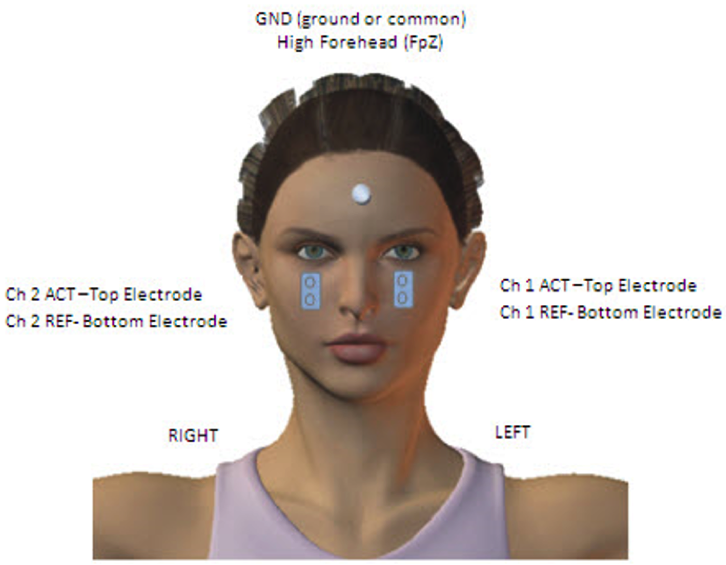 Electrode placement for oVEMP on patient's face