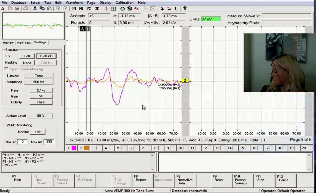 VEMP recording in the Otometrics EP 200