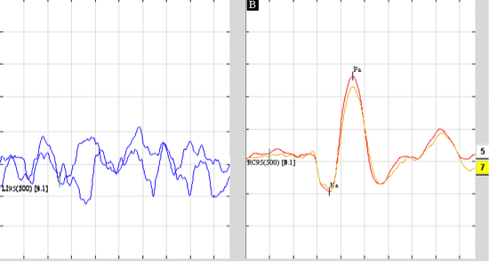 An oVEMP recording with an absent response from the left ear