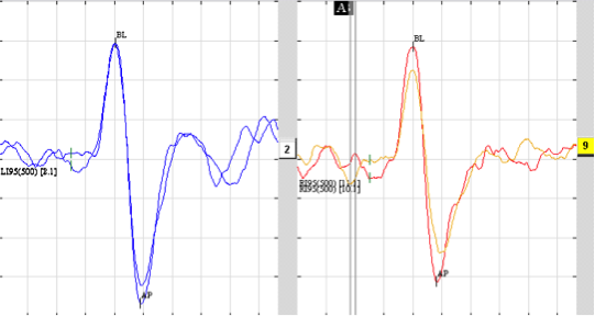 A normal cVEMP response bilaterally