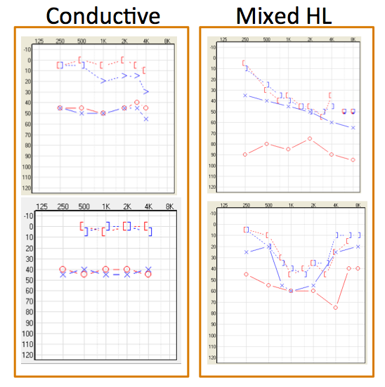 Conductive vs mixed hearing loss