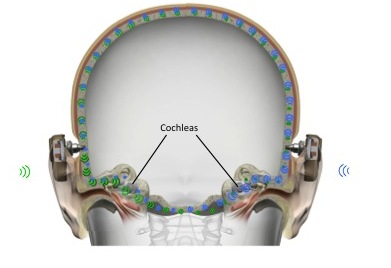 Symmetrical bone conduction thresholds are required for bilateral bone anchored devices