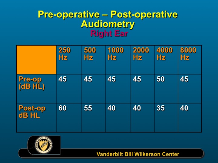 Pre-post op audiograms