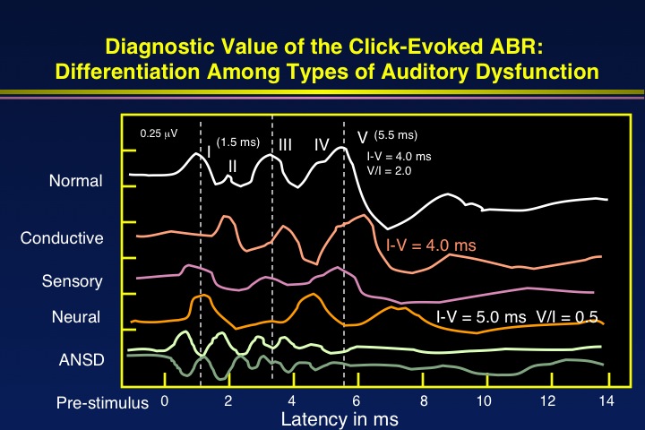 Examples of click-evoked ABRs with various types of auditory dysfunction