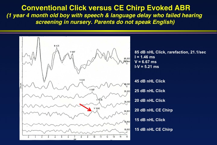 Click versus CE-Chirp Evoked ABR comparison for child age 1 year 4 months
