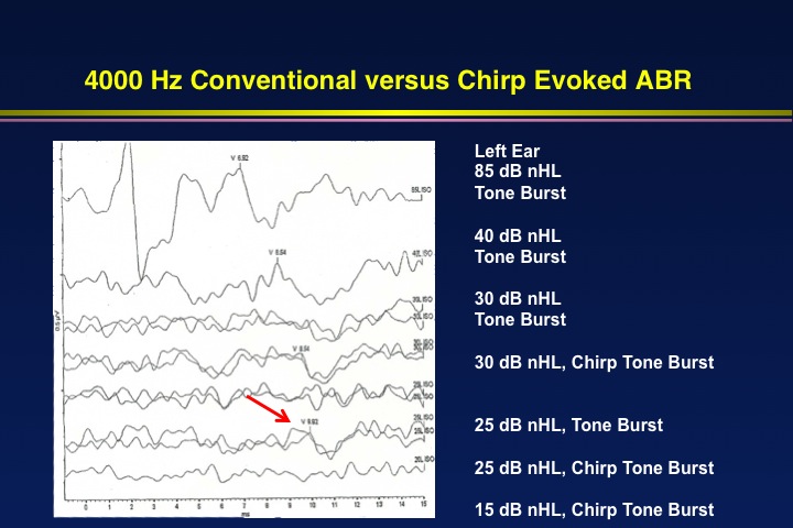 4000 Hz conventional versus chirp evoked ABR on a 1 year 4 months old child